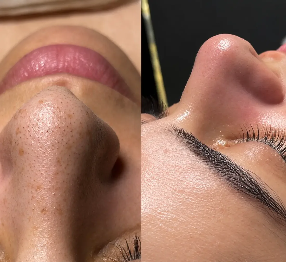 Close-up of skin before and after a deep-cleansing treatment